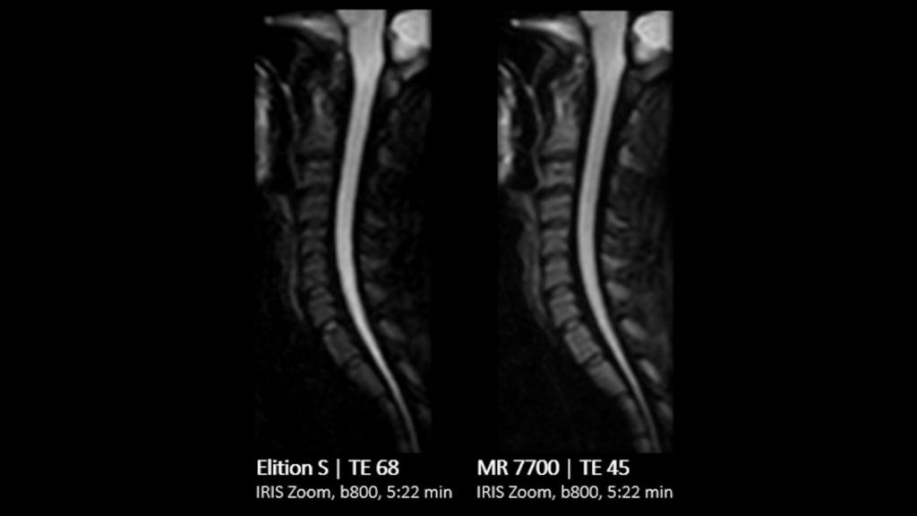 C-Spine Comparison IRIS ZOOM b800