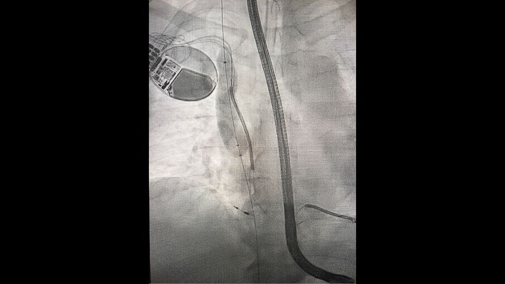Fluoroscopy of Bridge Plus – Image courtesy of Dr. Kiel, Sentara