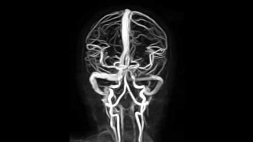 Non-CE MRA (3D PCA)