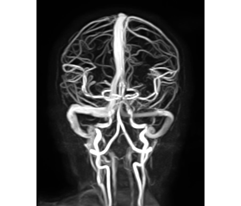 Non-CE MRA (3D PCA)