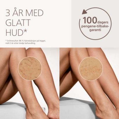 Philips Lumea IPL 7000