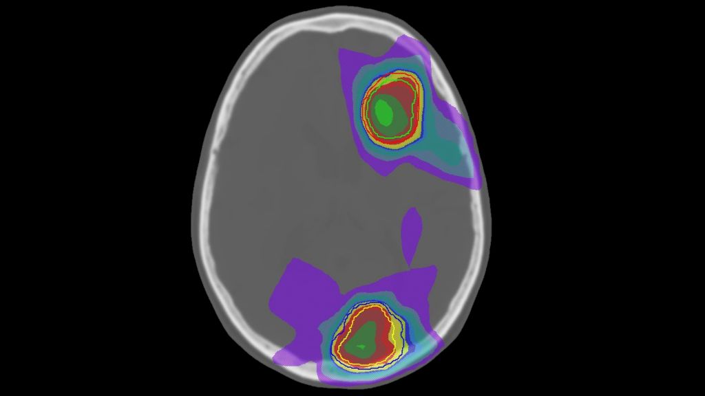 MRCAT Brain MR-RT clinical application