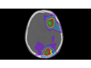 MRCAT Brain Клиническое приложение MR-RT