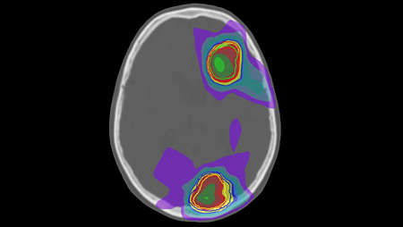 MRCAT Brain MR-RT clinical application