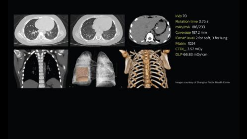Low-dose pediatric chest imaging