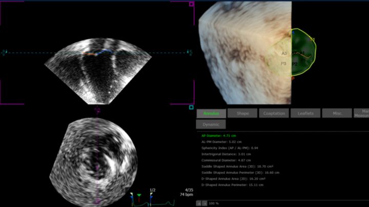 TomTec 4D MV-Assessment