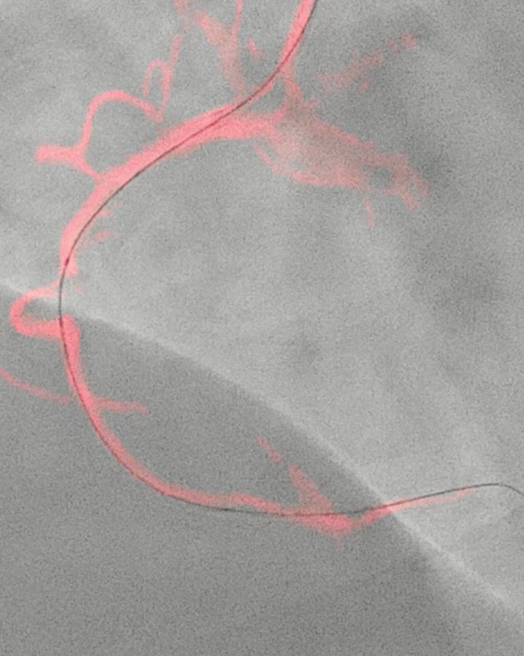Philips Dynamic Coronary Roadmap