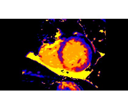 CardiacQuant - T1 map