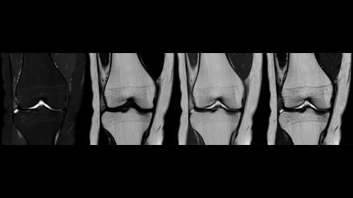 T2w mDIXON XD TSE - Knee