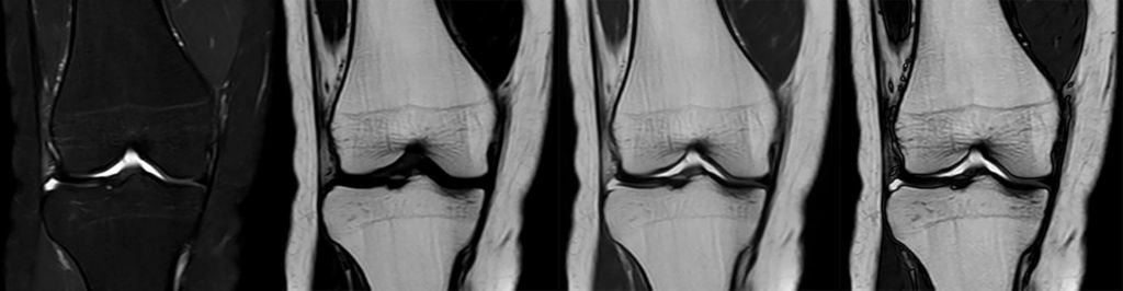 T2w mDIXON XD TSE - Knee