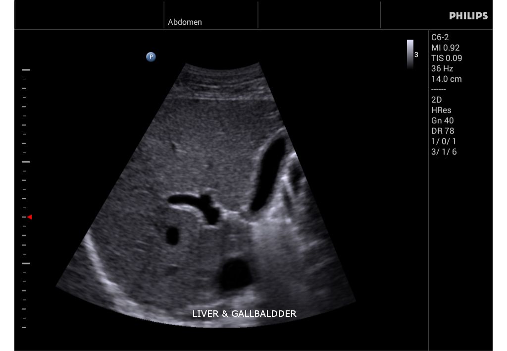 InnoSight clinical image liver and gallbladder
