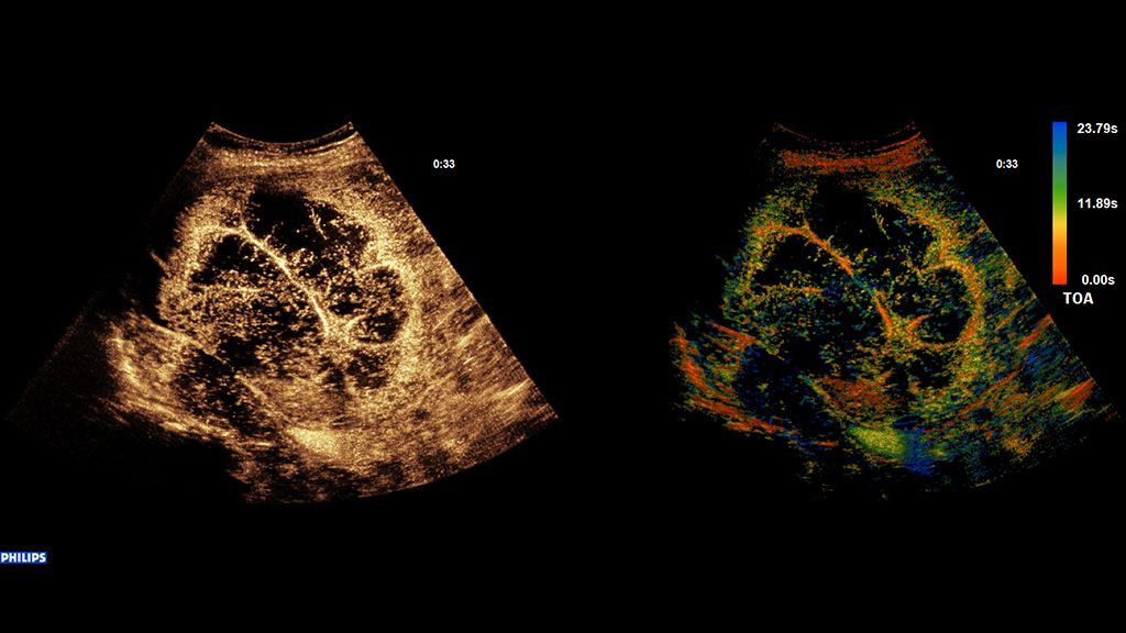 SuperRes MVI Pro ICC clinical image