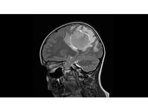 Compressed SENSE - Brain MR Clinical Applications