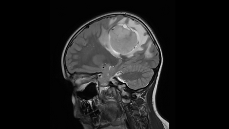 Compressed SENSE - Brain MR Clinical Applications