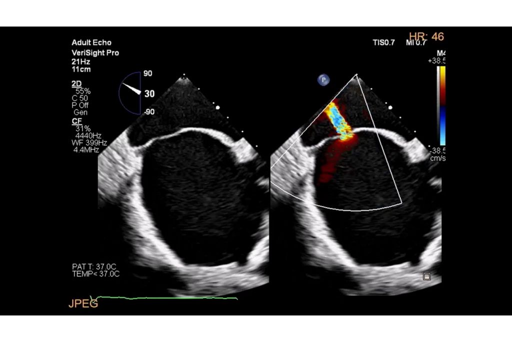 Interatrial septum flow using color