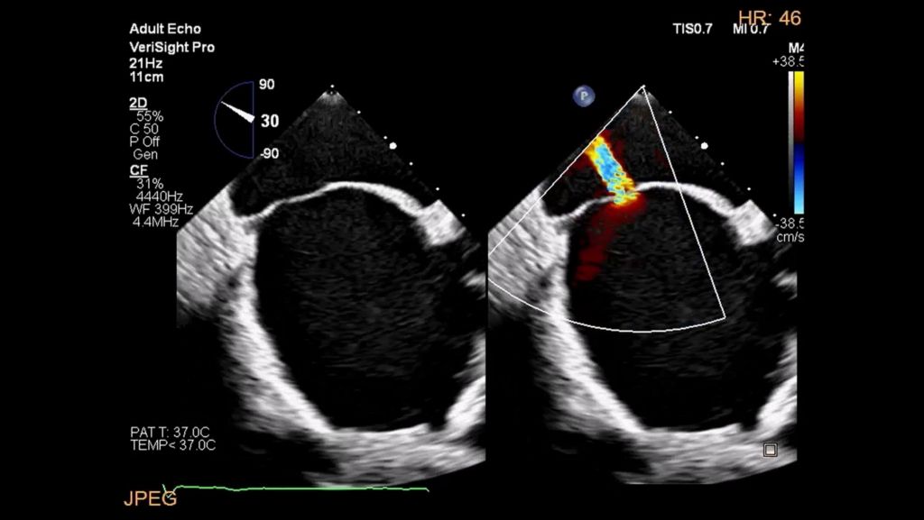 Interatrial septum flow using color