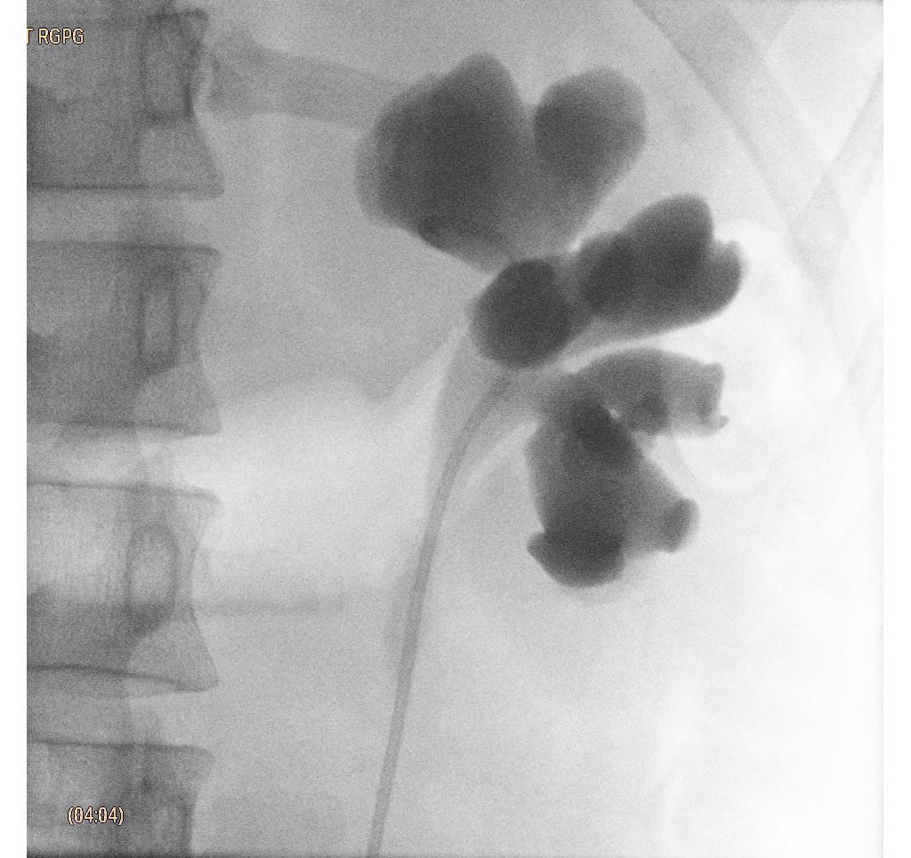 Clinical Image Philips Veradius Unity Mobile C-arm with Flat Detector