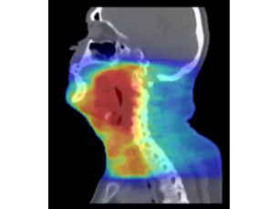 MRCAT Head and Neck MR-RT clinical application