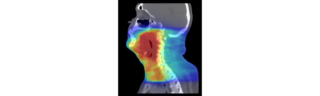 MRCAT Head and Neck MR-RT clinical application