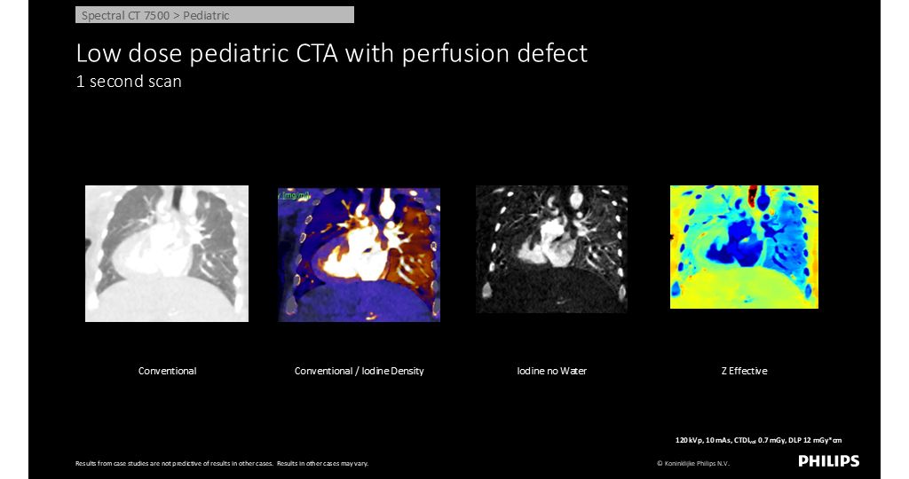 CT Spectral 7500 Pediatric - Low dose pediatric CTA with perfusion defect