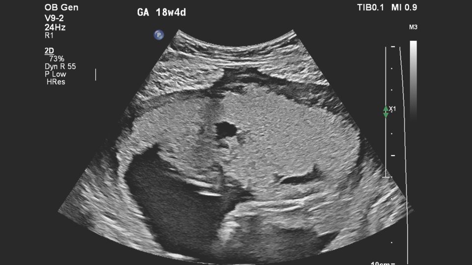 Figure 3 V9-2 transducer sagittal image of suspected placental abnormality