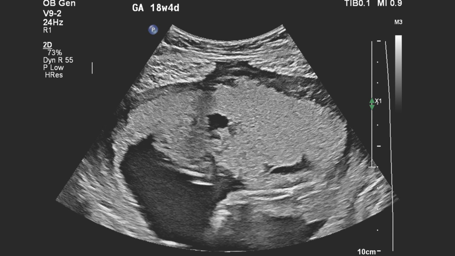 Figure 3 V9-2 transducer sagittal image of suspected placental abnormality