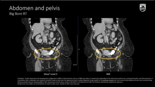 BBRT Abdomen and Pelvis