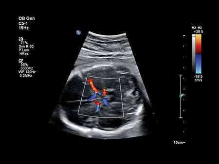 C5-1 Fetal Head Imaging