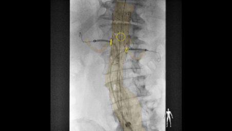 Fusión de imágenes 3D en procedimientos endovasculares