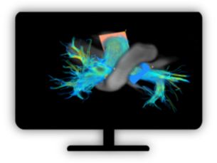 MR Caas 4D flow​ Visualization and quantification of blood flow