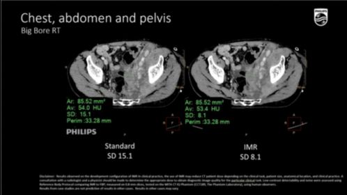 BBRT Chest abdomen pelvis