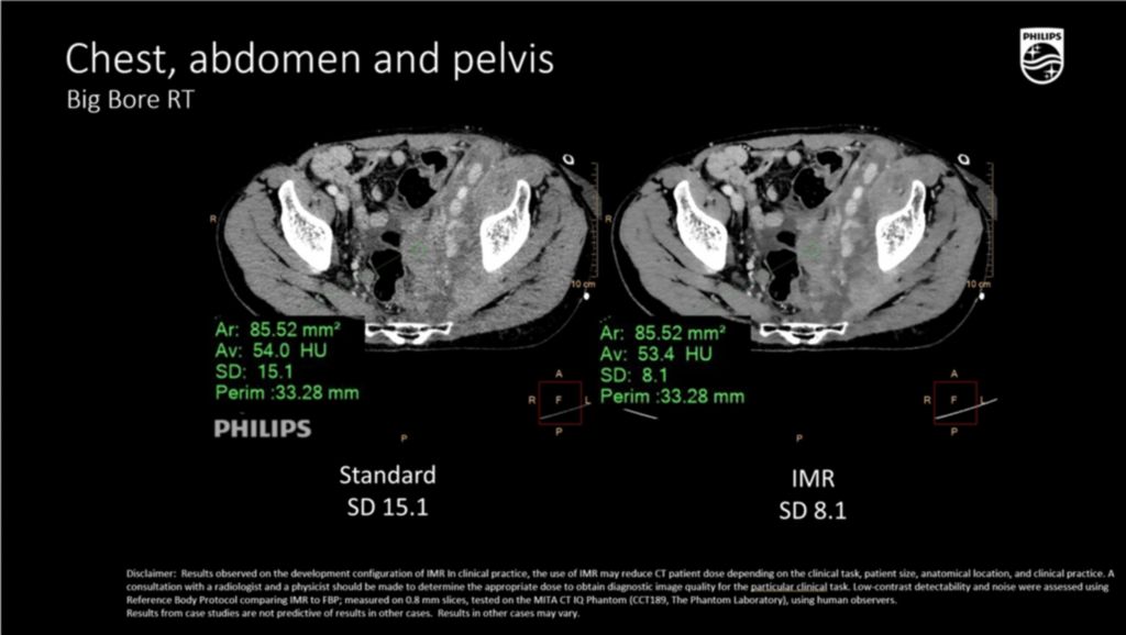 BBRT Chest abdomen pelvis