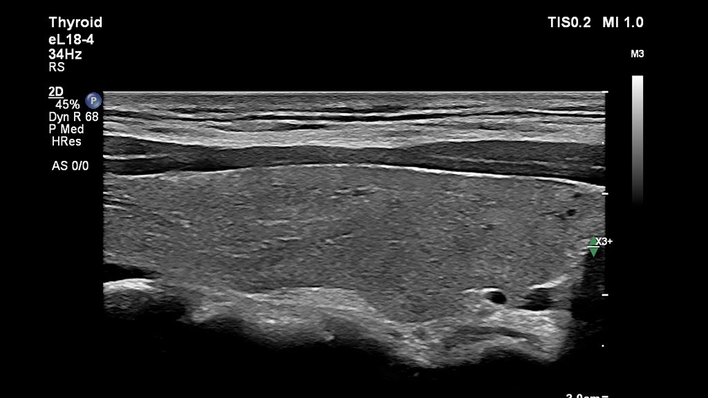 Clinical image using EPIQ Elite and eL18-4 transducer showing thyroid in 2D