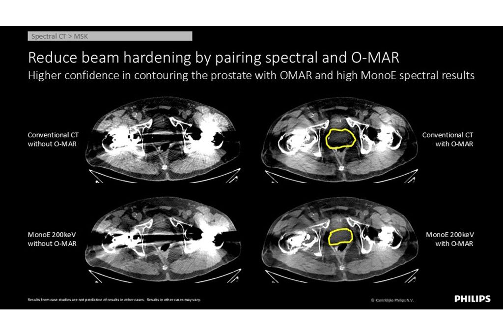 Spectral CT – MSK