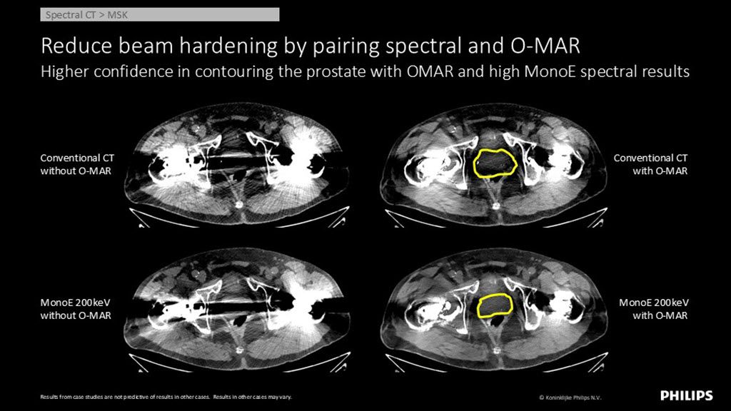 Spectral CT – MSK