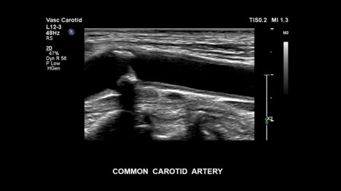Common carotid artery