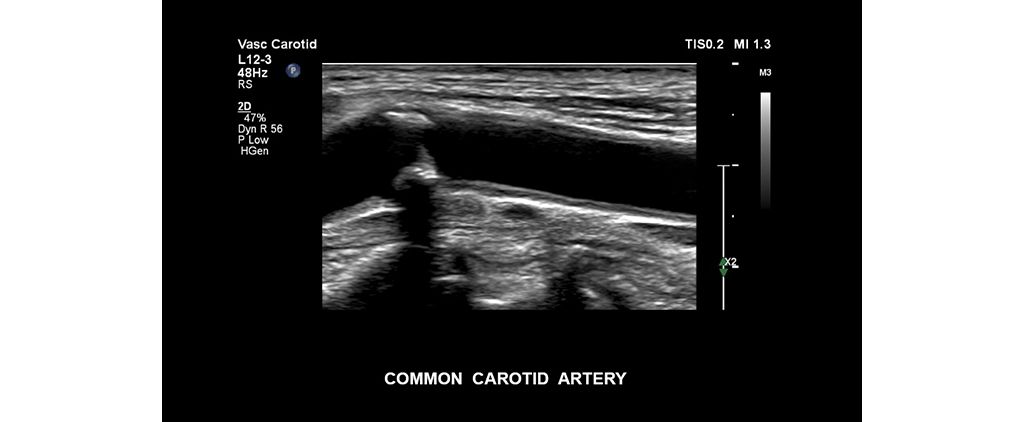 Common carotid artery