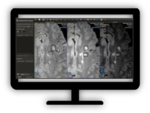 MR Longitudinal Brain Analysis (LOBI) Visualize subtle changes in brain images over time