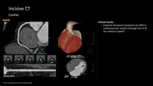 Incisive CT CT Scanner | Philips