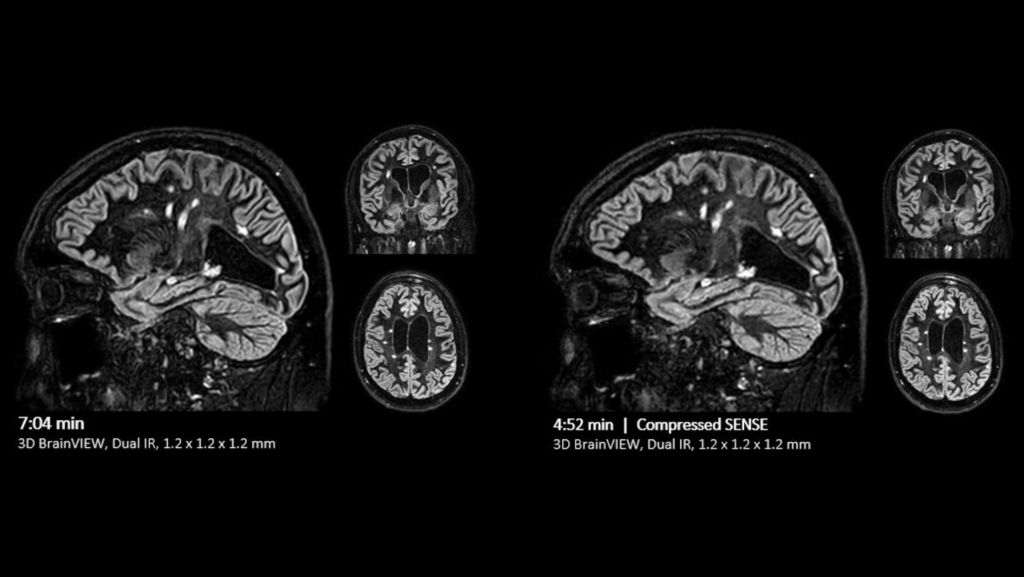 Brain comparison Compressed SENSE