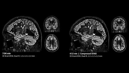 Brain comparison Compressed SENSE