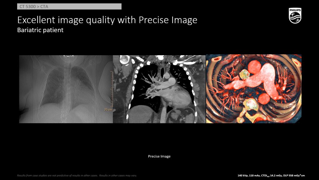 CT 5300 Bariatric