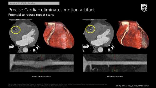 CT Spectral 7500 -Cardiac MCR Precise Cardiac