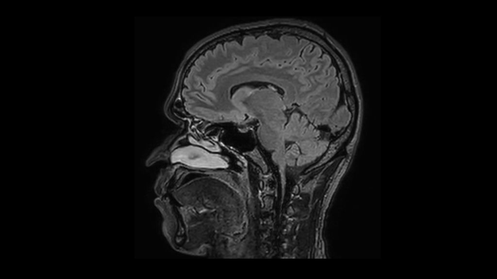 3D FLAIR clinical image of the brain