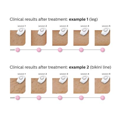 Philips Lumea Comfort