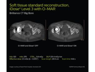 O-MAR Redução de artefato de metal para implantes ortopédicos