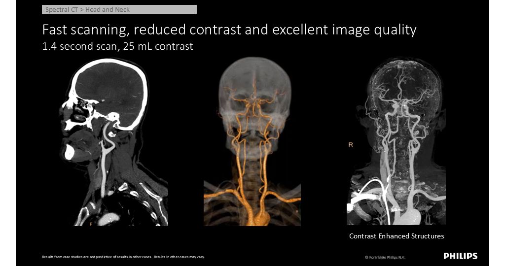 CT Spectral 7500 Head & Neck - Fast scanning, reduced contrast and excellent image quality