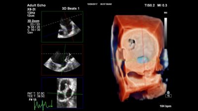 3D cardiac ultrasound imaging displayed on Philips EPIQ CVx system screen
