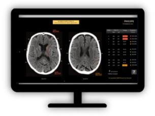 CT ASPECT Scoring ASPECTS for CT images to assess the ischemic stroke patients