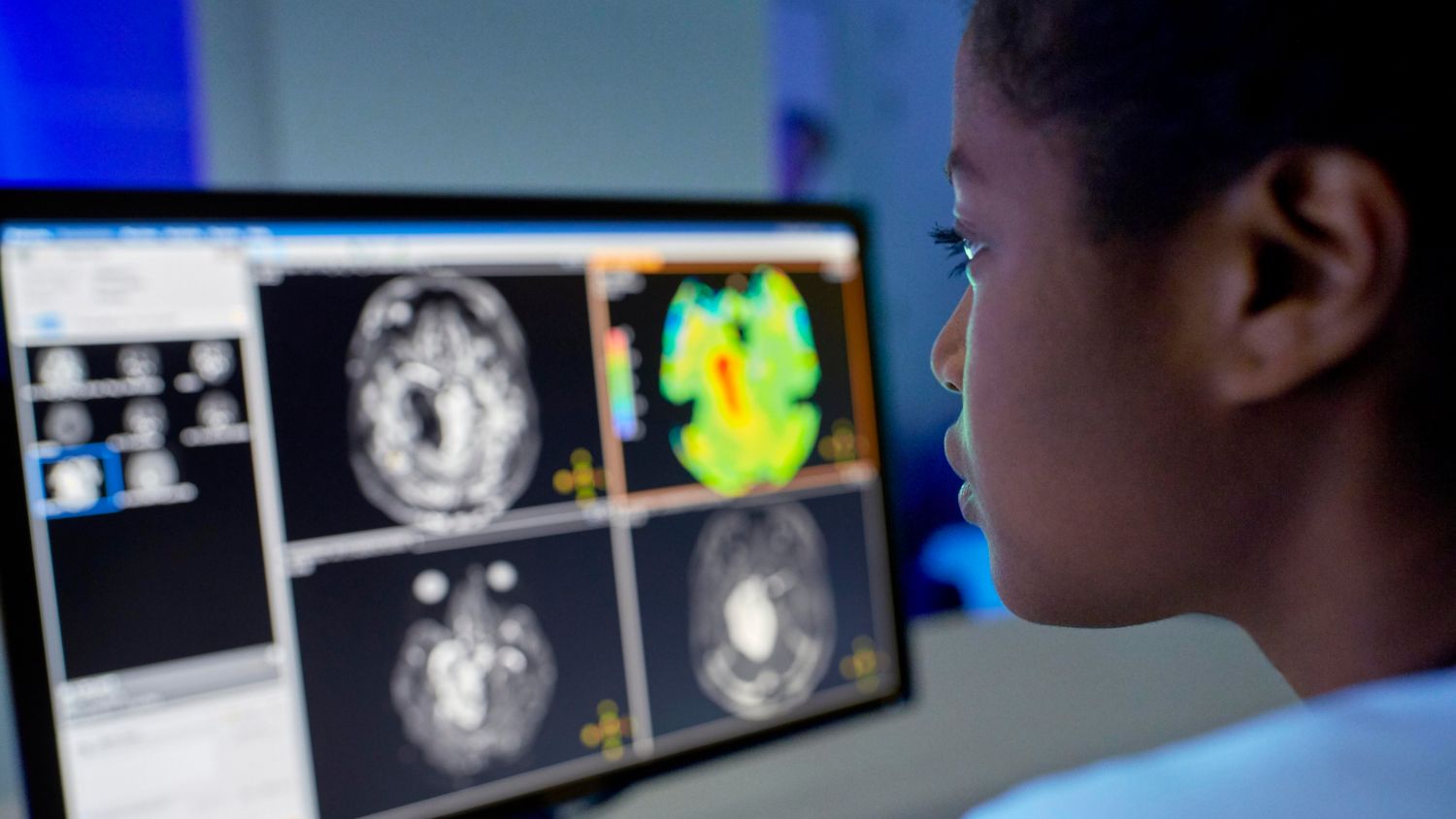 Enhancing brain tumor MRI with APT weighted imaging